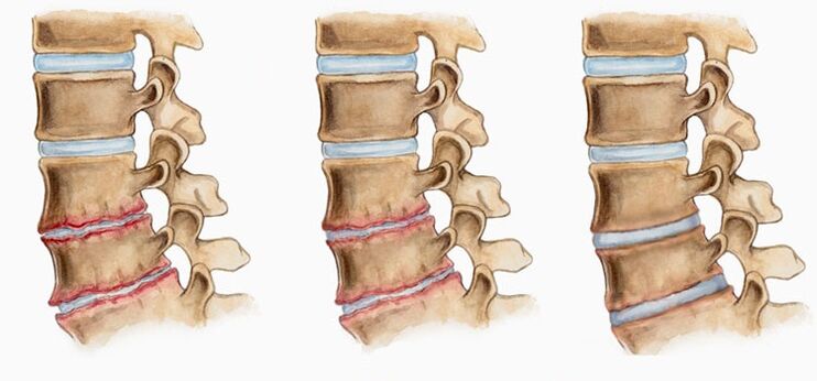 Sự biến dạng của các đĩa đệm trong quá trình thoái hóa xương có thể gây ra đau lưng