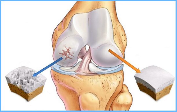Arthrosis của khớp gối
