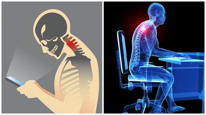 làm việc ít vận động và đi khom lưng là những lý do cho sự phát triển của bệnh hoại tử xương