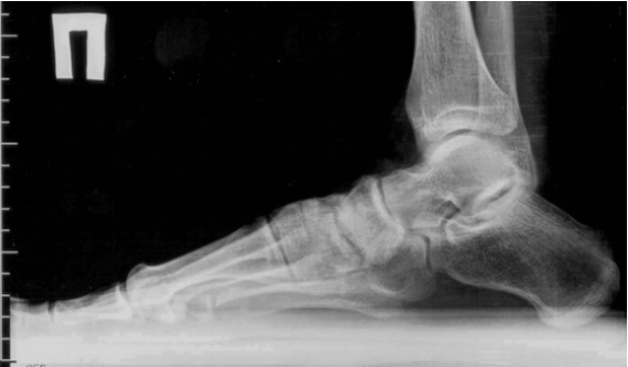 Arthrosis của ngón chân và bàn chân
